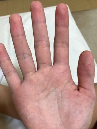 ひいきにする 小数 平行 白癬 菌 手 Naoshi Biz