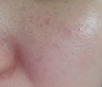 最近肌荒れに悩まされています 皮膚科には行く予定ですが しばらく行けそうにな Yahoo 知恵袋