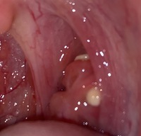 汚い画像でごめんなさい臭い玉が数日前からふたつありますうがいしても Yahoo 知恵袋