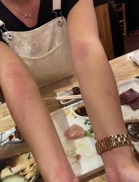 お酒を飲むと赤い斑点の様なものができます これってなんでしょうか Yahoo 知恵袋