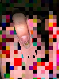 グリーンネイルになりました グロ画像すみません 今日 急いでネイルサロン Yahoo 知恵袋