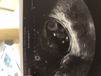 エコー写真での性別について 本日12週0日でエコーをしてきました Yahoo 知恵袋