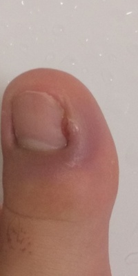 ひょう疽 巻き爪の様になっているものを取ったところひょう疽のようなものになっ Yahoo 知恵袋