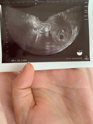 5w2dで胎嚢確認したのですがよくみる皆さんのエコーより胎嚢の位置 Yahoo 知恵袋