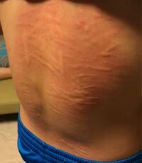 背中が急に痒くなってがーってかくと全体にたくさんのぶつぶつ が Yahoo 知恵袋