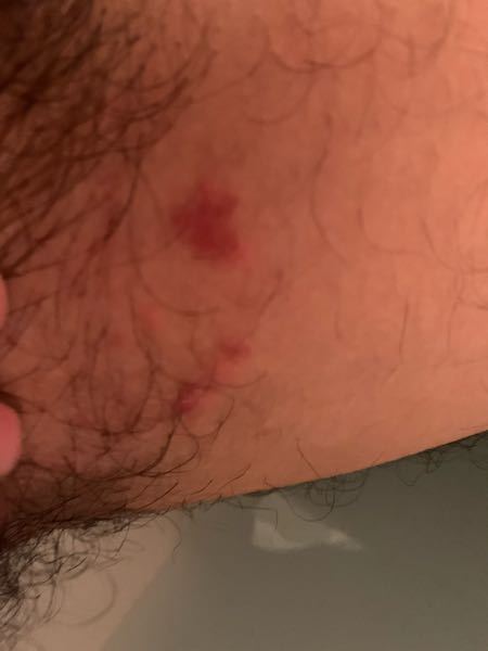 袋 痒い 玉 近