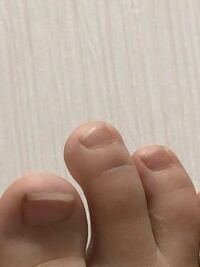 足の指が骨折 又はひびが入ったときどんな症状が出ますか 2日前 友達と Yahoo 知恵袋