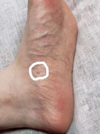 閲覧注意数日前から足の裏にポチッとしたものができました 痛くも痒くも何ともな Yahoo 知恵袋