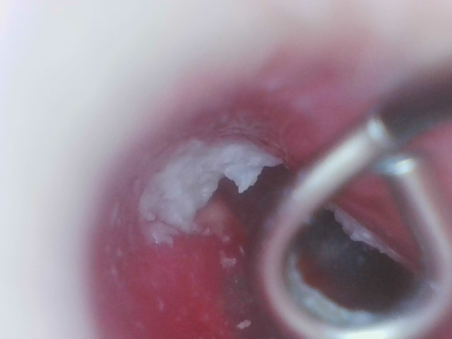 グロ注意耳垢取る方法ないですか 鼓膜近くの耳垢ですね A乾燥タ Yahoo 知恵袋