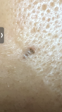 これは皮膚癌ですか 子供の頃からあった巨大なほくろを7年くらい前に取った場所 Yahoo 知恵袋