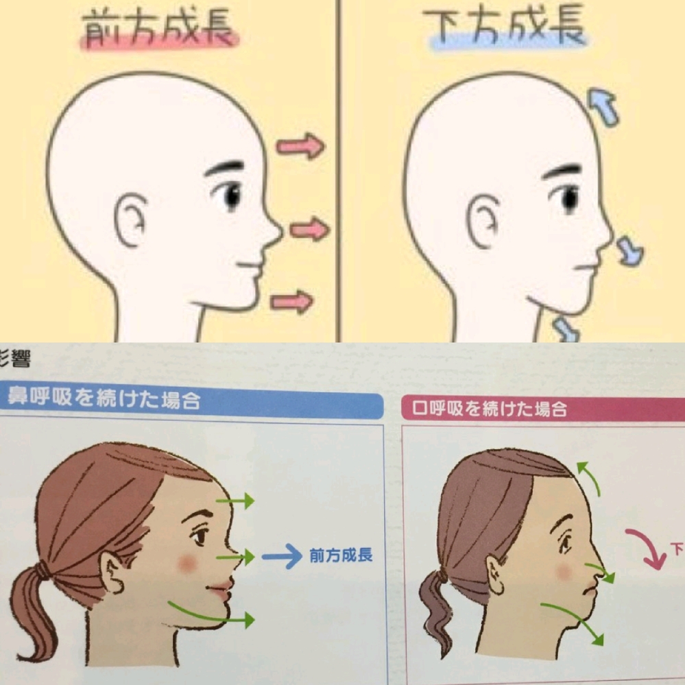 アデノイド 顔 画像