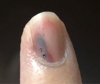 血腫 爪 下