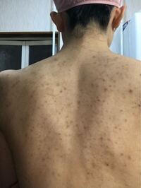 背中 ニキビ跡 ひどい 薬