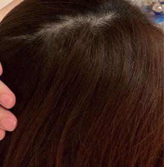 代前半女です ここ数ヶ月抜け毛が酷く 元々つむじが薄い気がしてたのですが Yahoo 知恵袋
