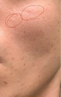 ニキビ最近 頬というか目の下 にニキビのような少し赤く盛り上がって Yahoo 知恵袋