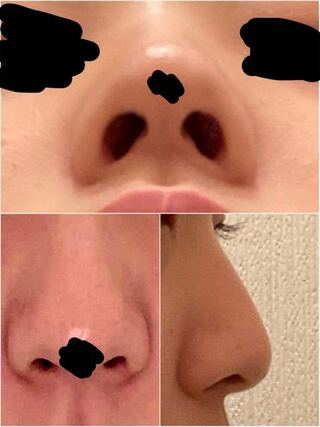 こちらは何鼻でしょうか 身バレ防止の為ほくろと目元を隠してあります Yahoo 知恵袋