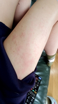 こんな感じの蕁麻疹 が太もも ふくらはぎ 腕に出ています ブツ Yahoo 知恵袋