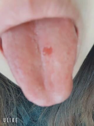 真ん中 が 痛い 舌 の