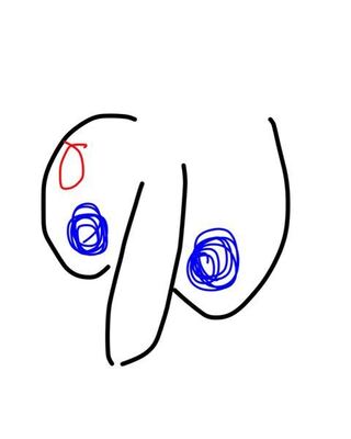 睾丸 しこり 精巣 睾丸 が腫れた その原因は 治療法や病院へ行く目安は