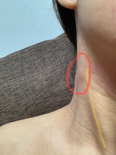 胸鎖乳突筋 しこり に関するq A Yahoo 知恵袋