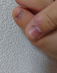 画像閲覧注意 足や手の爪を剥いだり その周りの皮を血が出るまで剥く癖を治 Yahoo 知恵袋