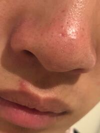 週一でクレンジングオイルとクレイパックの角栓除去をしているのですが Yahoo 知恵袋