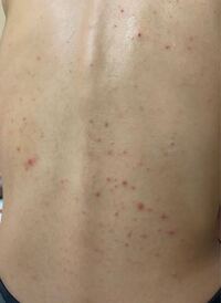 背中のでき物 代前半女性です 背中のでき物がずっと治らず困っています Yahoo 知恵袋