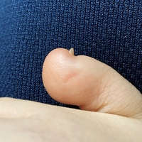 足の爪の形について 足の小指の爪の形がすごく反っています写真は爪を横か Yahoo 知恵袋