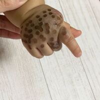 11ヶ月の息子の異所性蒙古斑についての質問です 少々痛々しい画像 Yahoo 知恵袋