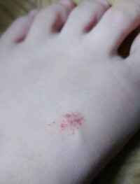 の 甲 赤い 斑点 足 足の甲に小さな赤い斑点がある 目で見てわかる病気のサイン