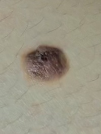 メラノーマの疑いのあるホクロについて 高校生です 生まれつきホクロが出来 Yahoo 知恵袋