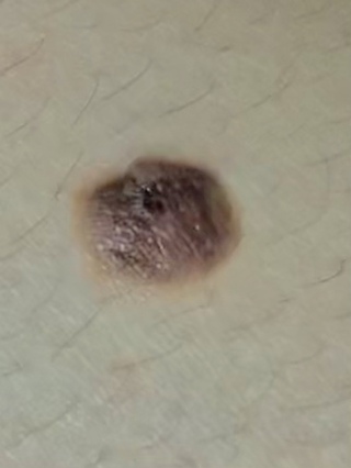 メラノーマの疑いのあるホクロについて 高校生です 生まれつきホクロが出来 Yahoo 知恵袋