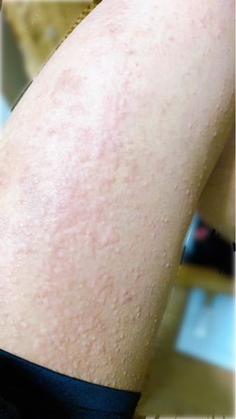 皮膚の病気 アトピー 解決済みの質問 Yahoo 知恵袋