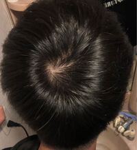 高３です これってつむじハゲ始まってますか 最近あわせ鏡をしてヘア Yahoo 知恵袋