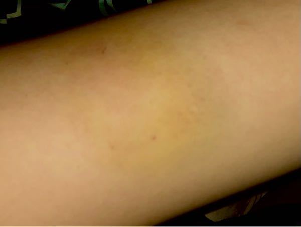 彼氏に腕を強く噛まれたんですが、3日経った今でも押したら痛くて、写真ではわかりづらいですが噛まれた場所が黄色く変色してます。 これは時間が経てば治りますか?? 痕が残るくらいに噛まれたのが初めてなのでわからないです。