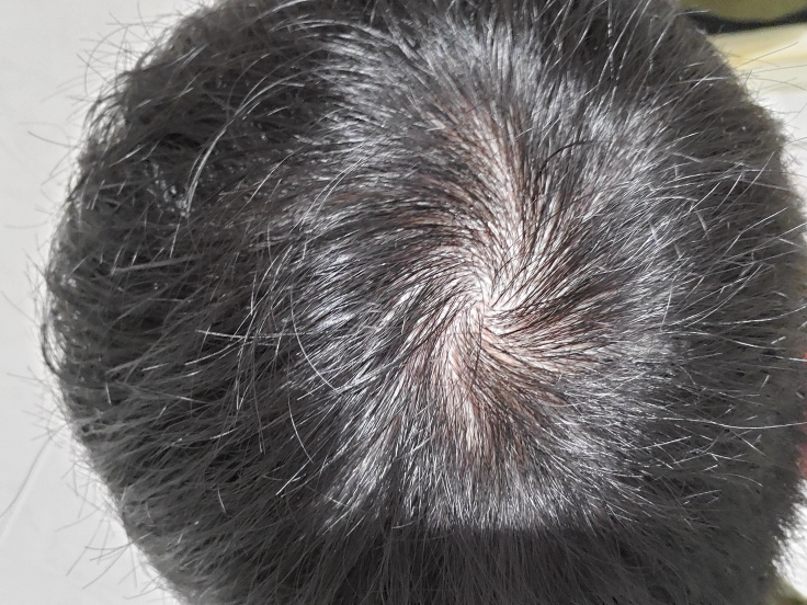 19歳です 最近つむじが気になってて つむじ割れとか起きたりし Yahoo 知恵袋