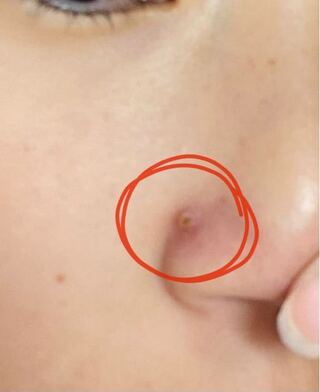 角栓を抜いてしまい穴が出来たあと写真の様なものが出来てしまいました Yahoo 知恵袋