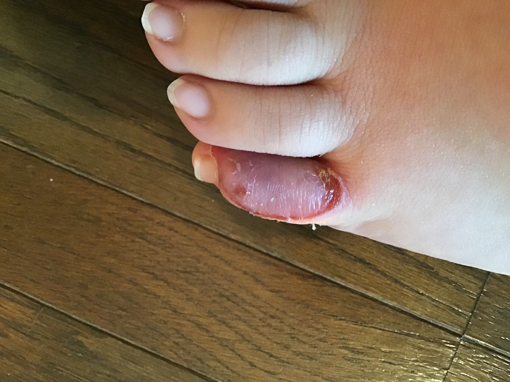 これって しもやけですか 全く痒くも痛くもないんですが しもやけとは Yahoo 知恵袋