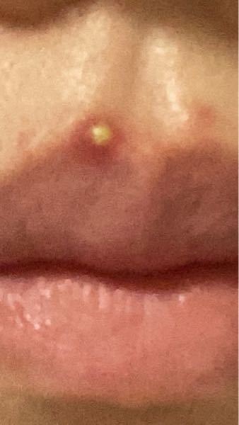 ニキビケア すべての質問 Yahoo 知恵袋