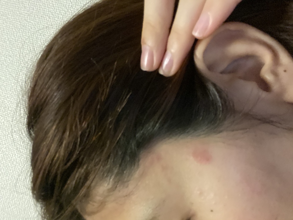 肌の赤みについて画像のように生え際に赤い湿疹ができています わたし Yahoo 知恵袋