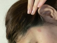 肌の赤みについて画像のように生え際に赤い湿疹ができています わたし Yahoo 知恵袋