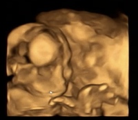 21週4日のエコー写真です 4dの写真ですが 右目の上にあるコブみたいな白い Yahoo 知恵袋