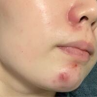 鼻と顎ニキビについて悩んでます 2週間前から出来て鼻は治ったのにまた出 Yahoo 知恵袋