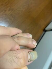 足 の 親指 の 爪 が 剥がれ た