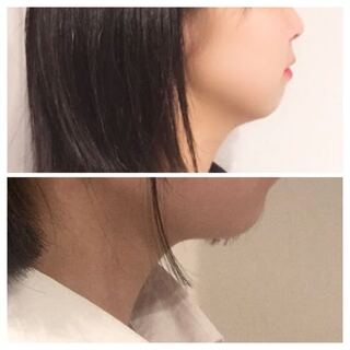 アデノイド 顔 画像