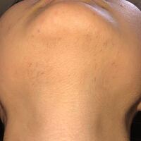 女性のあごひげで本気で悩んでいます 27歳女です 19歳 くらい Yahoo 知恵袋