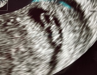 妊娠6週5日です エコー写真をもらったのですが 胎嚢がものすごく細 Yahoo 知恵袋