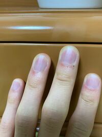 小学生の頃 爪を噛む癖があったせいか 爪 ピンクの部分 が他の人より短く 全 Yahoo 知恵袋