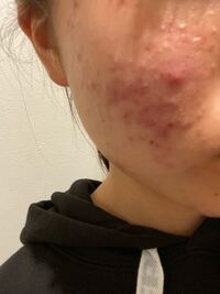 中学生女子のニキビ マスクなしでは人と目を合わせて会話ができません 中 Yahoo 知恵袋