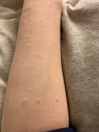 なんかここ2 3日で腕に変なポツポツが大量にできました 痛く Yahoo 知恵袋